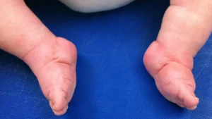 تشوهات الأطراف والنمو عند الأطفال مع د. قتيبة درويش – رعاية مبكرة لبدايات صحية
